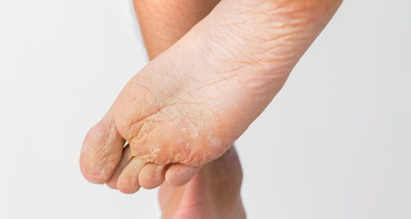 Athlete's Foot Care in West Islip, Long Island
