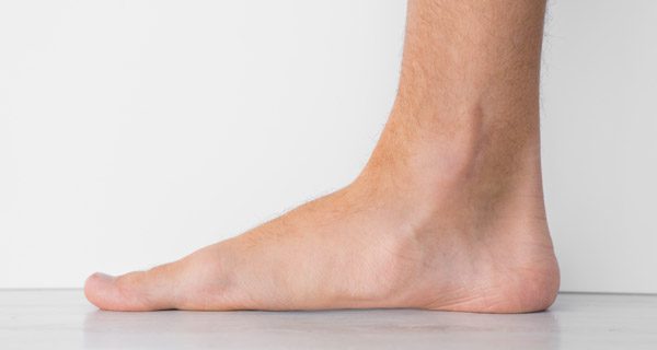 Flat Foot Care in West Islip