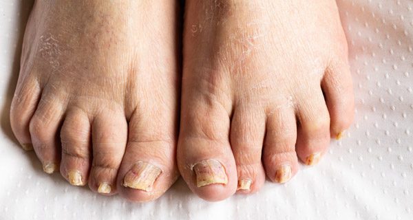 Fungal Nail Problems - Ipswich Podiatry Centre